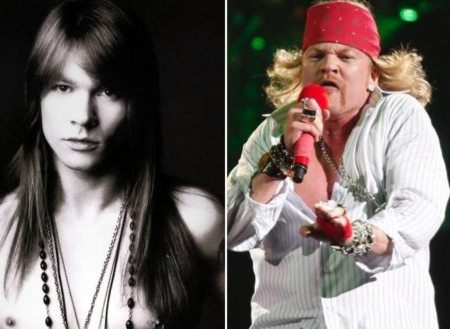 Celebrity-Plastic-Surgery-Fails-Before-And-After-Axl-Rose