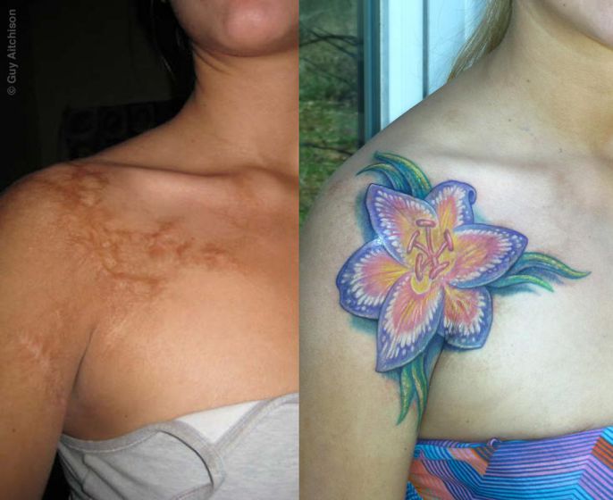 Tattoos-Covering-Scars-9